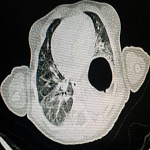 La hernie diaphragmatique congénitale une pathologie pas toujours