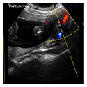 Uterine artery Doppler study in second trimester of pregnancy