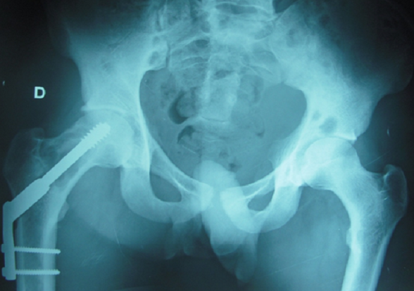 Figure 3 from Une hanche douloureuse révélatrice d'une histiocytose osseuse  multifocale