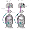 Contralateral facial nerve palsy following mandibular second molar ...