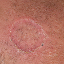 Cutaneous sarcoidosis simulating porokeratosis of Mibelli