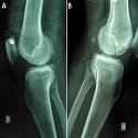 Hoffa fracture of medial unicondylar and bilateral in a man: a rare case