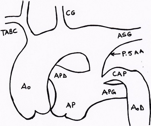 Figure Figure 3 Persistance du 5 sup me sup arc aortique