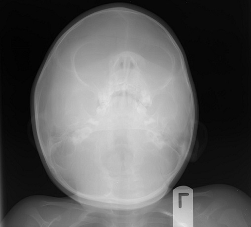 melanotic neuroectodermal tumour of infancy Melanotic Neuroectodermal Tumor of Infancy - an overview main image 0