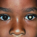 Presenting signs of retinoblastoma at a tertiary level teaching ...