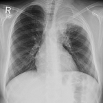 Aggregatibacter Actinomycemcomitans pneumonia mimicking lung cancer in ...