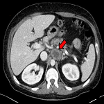 Pseudotumoral form of schistosomiasis mimicking neuroendocrine tumor: a ...