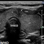 A community-based ultrasound determination of normal thyroid volumes in ...