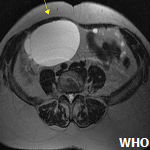 Benign multicystic peritoneal mesothelioma in a postmenopausal woman ...