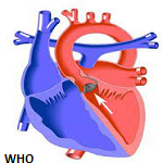 Sub-aortic tunnel stenosis complicated by infective endocarditis: a ...