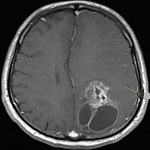 Sarcomatoid variant of urothelial carcinoma in the renal pelvis with ...