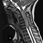 A rare presentation of a spinal diffuse midline glioma in a child: a ...