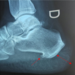 Bilateral carpal tunnel syndrome revealing an acromegaly: a case report