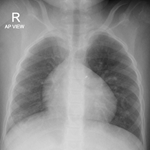 A rare presentation of childhood interstitial lung disease attributed ...