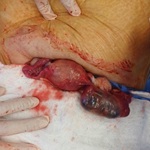 Unruptured ampullary ectopic pregnancy at 13 weeks of gestation with positive cardiac activity: an exceptional entity