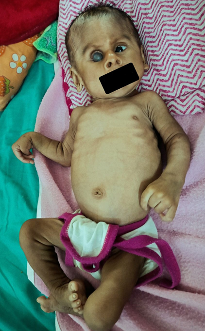 Clinical image of a 3-month-old male infant with Bohring Opitz syndrome demonstrating right eye anophthalmia with staphyloma