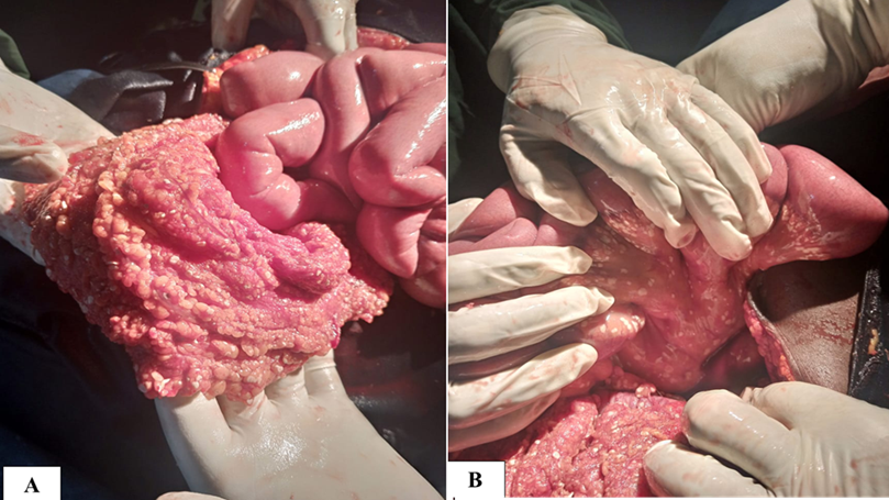 Candle wax fat necrosis in acute hemorrhagic pancreatitis