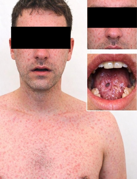 Classic morbilliform exanthem of measles in an unvaccinated adult: rare clinical image
