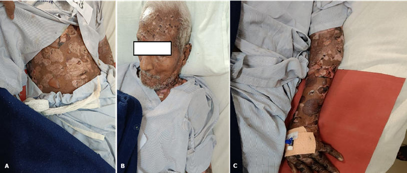 A distinctive clinical image depicting bullous pemphigoid in a 77-year-old male